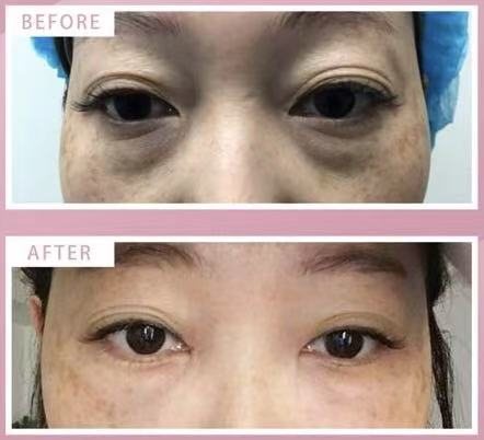 眼周疲惫感优化